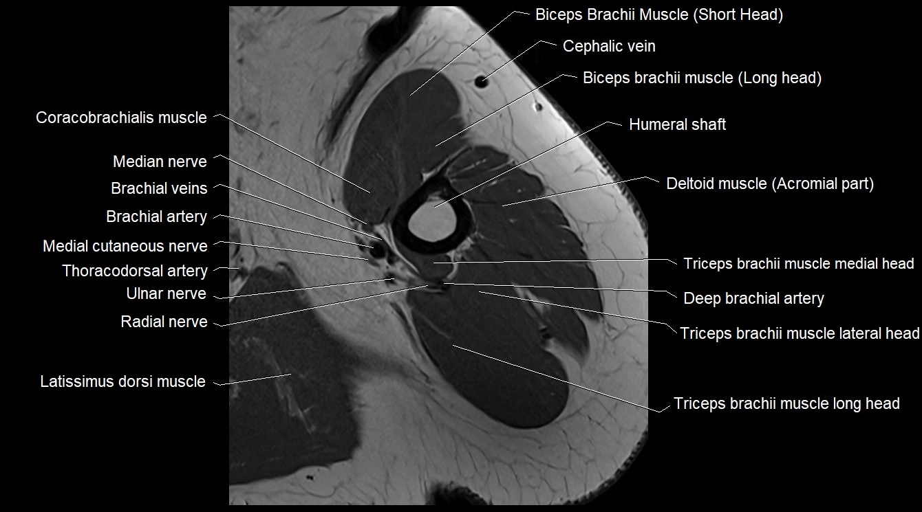 Upper arm( humerus) cross section anatomy MRI 3T axial image 25.webp